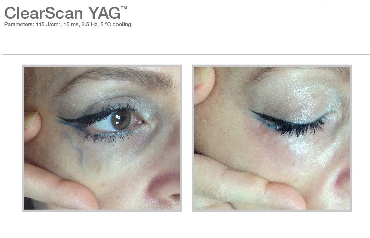 Veins-Laser-vein-removal-clear-scan
