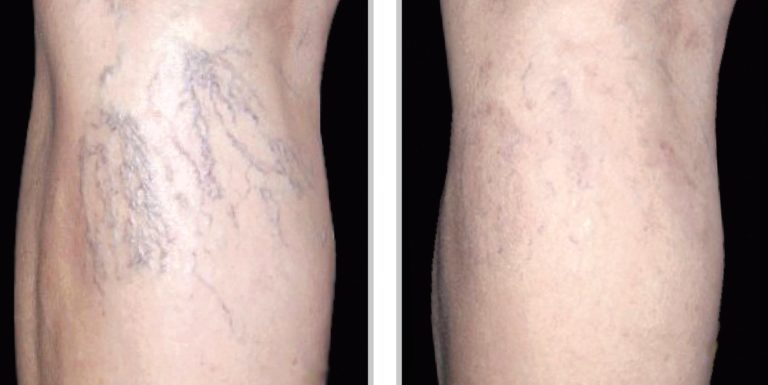Veins-Laser-veins-removal