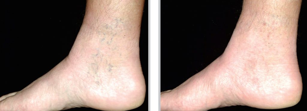 Sclerotherapy