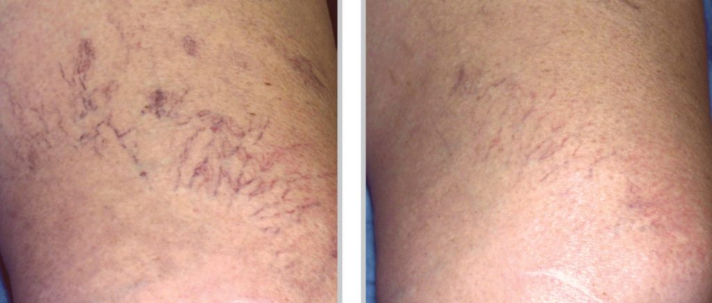 Sclerotherapy