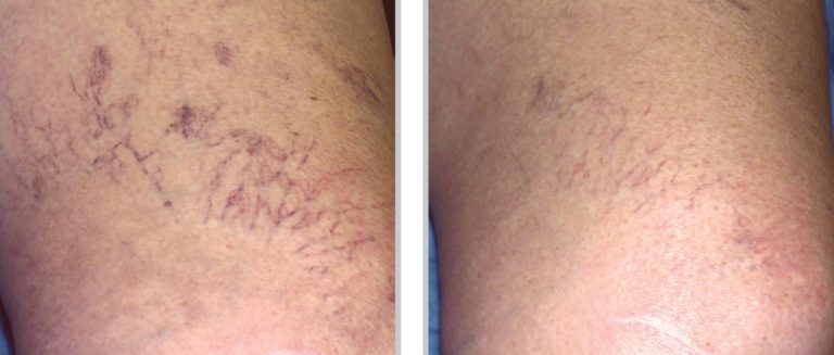 Veins-sclerotherapy