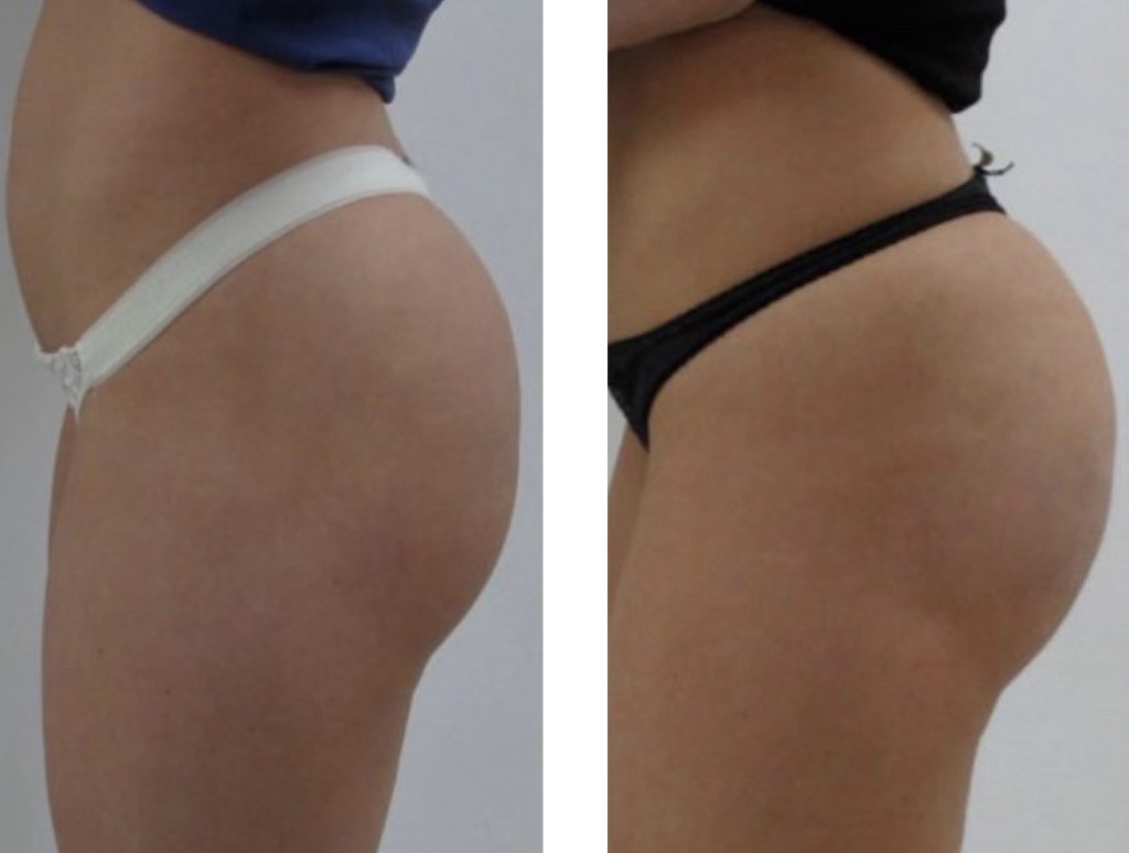fat-Transfer-6M-after