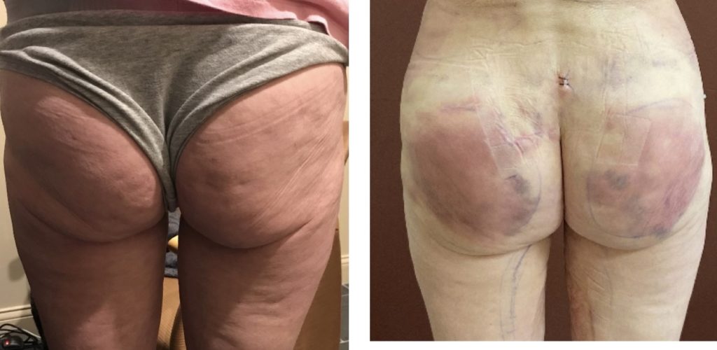 fat-transfer-2-days-after