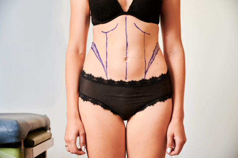 female-patient-body-with-marks-for-plastic-surgery