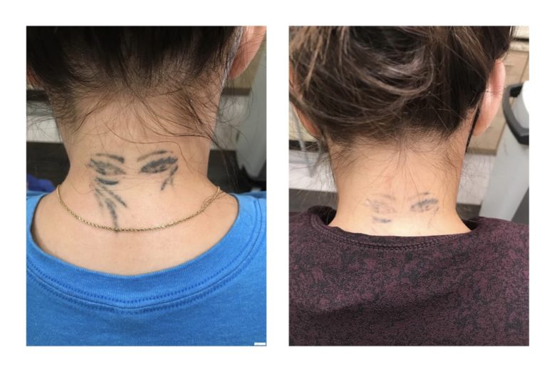 tatoo-removal-after